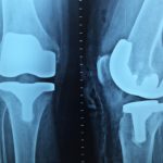 Artroskopia kolana – zabieg konieczny.